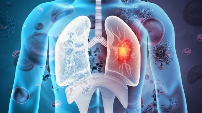 50 yaş üstü ve sigara kullanan kişiler dikkat! Uzmanlar uyarıyor: EN ÇOK AKCİĞER KANSERİ ÖLDÜRÜYOR –